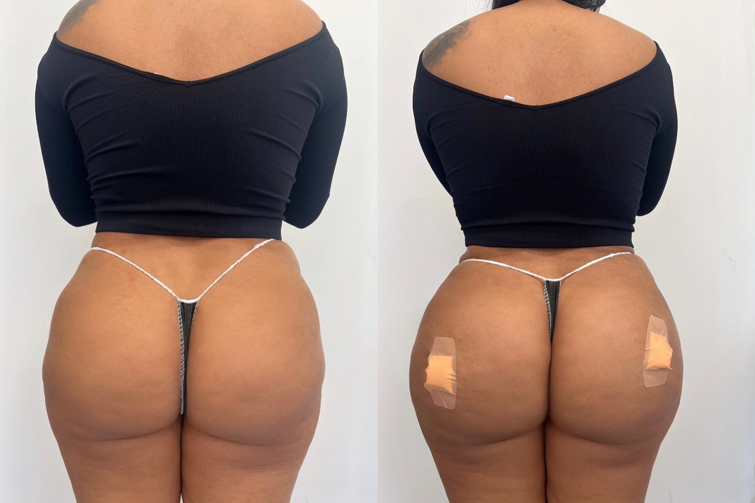 Before After Butt Enhancment Services (10)