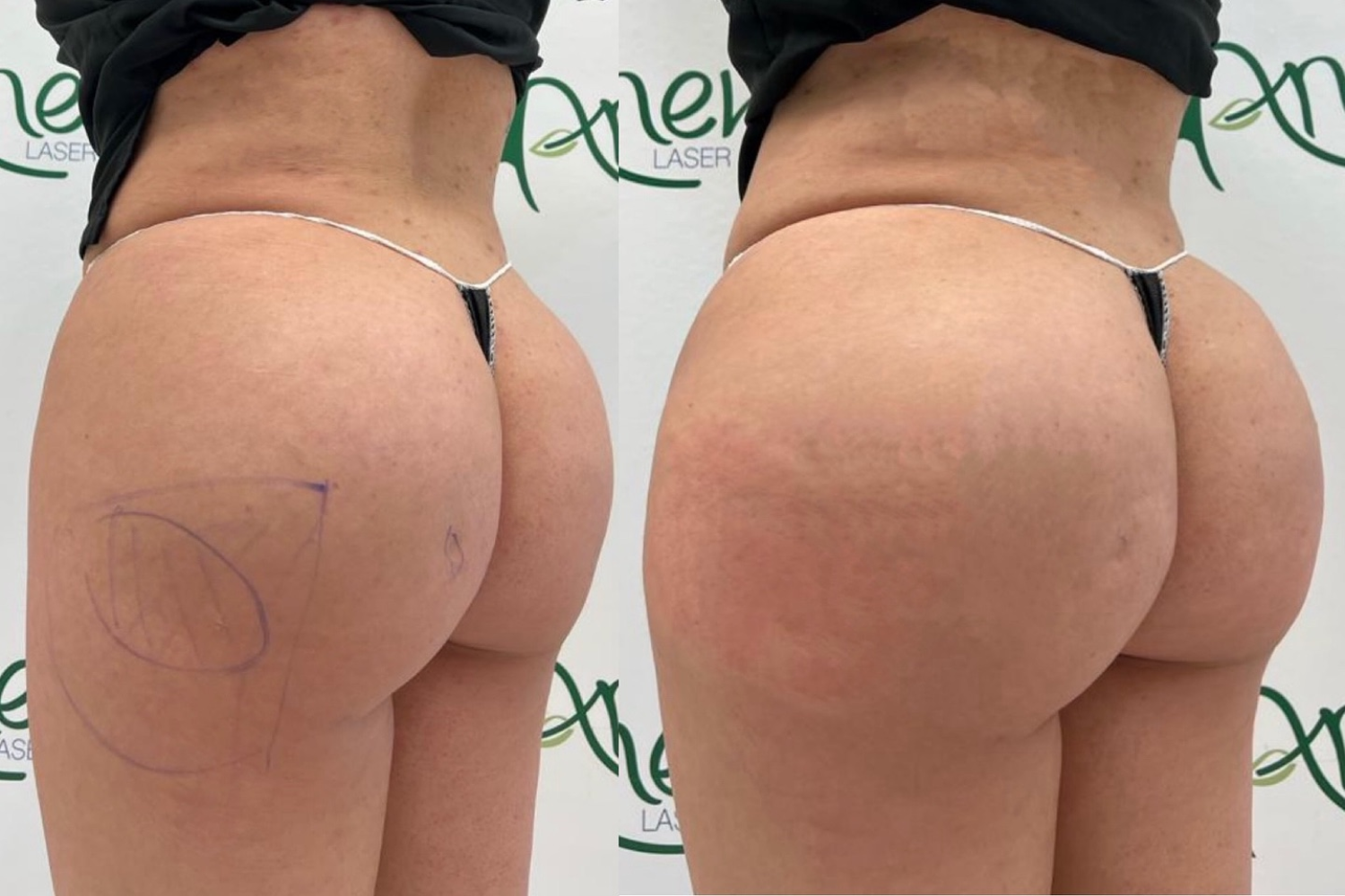 Before After Butt Enhancment Services (2)