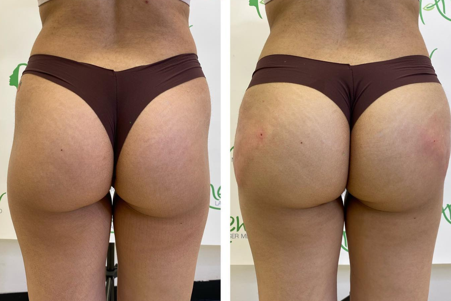 Before After Butt Enhancment Services (4)