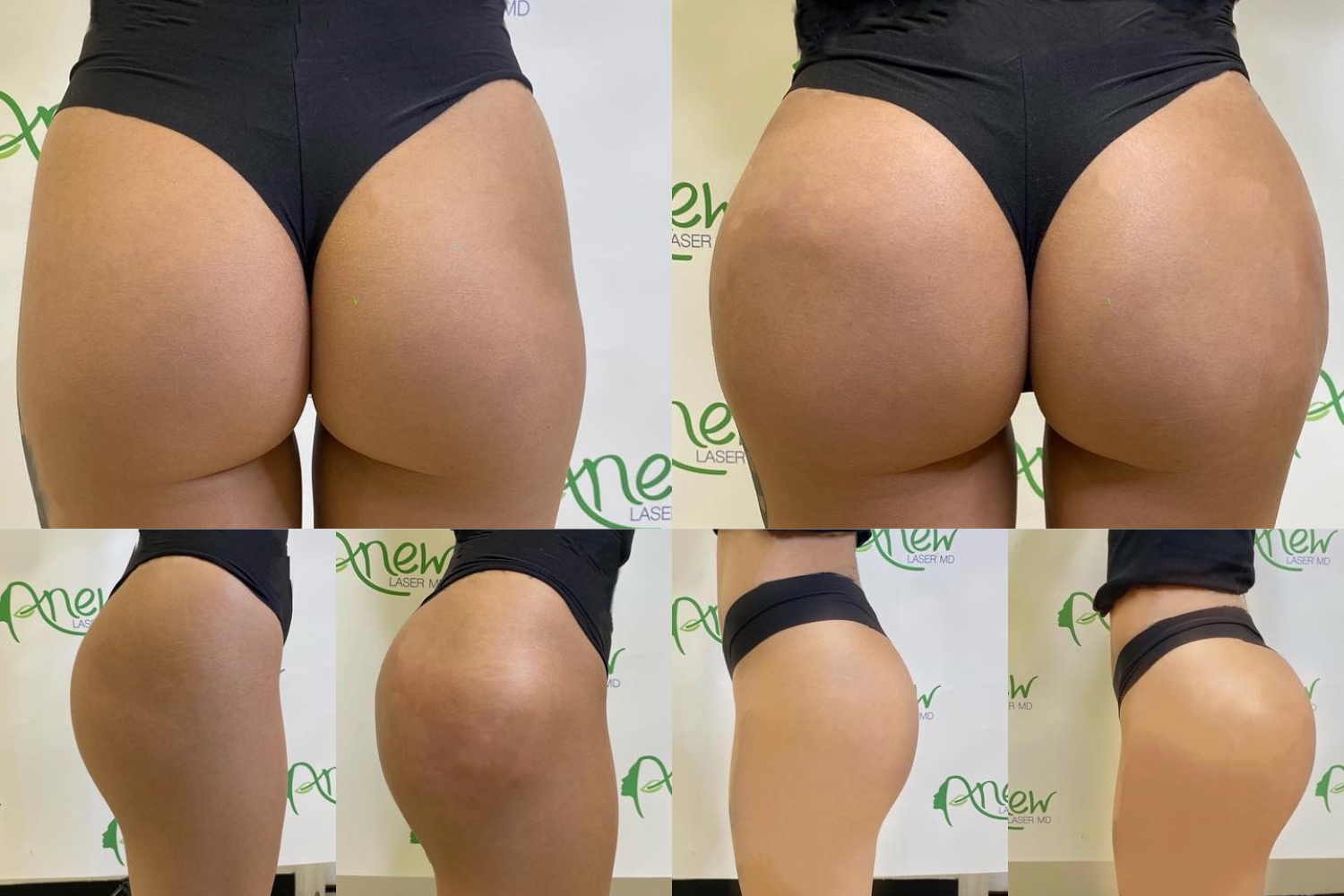 Before After Butt Enhancment Services (5)