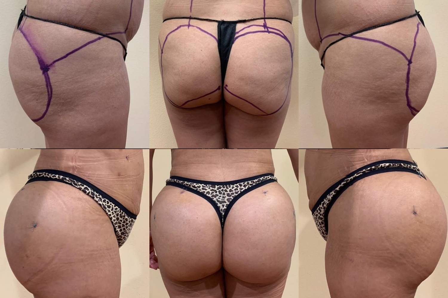 Before After Butt Enhancment Services (9)
