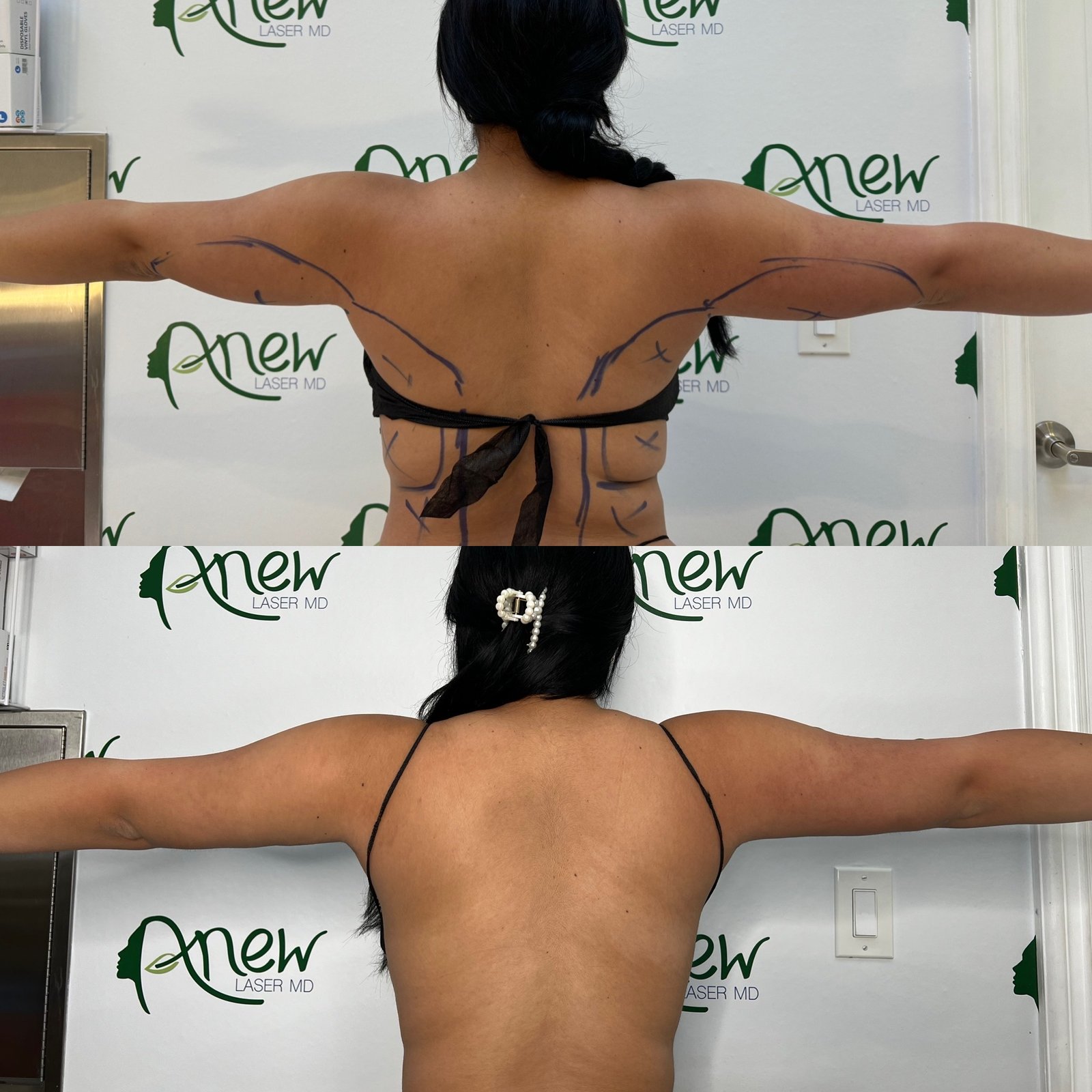 Lipo, BBl,, awake, sculptra results (1)