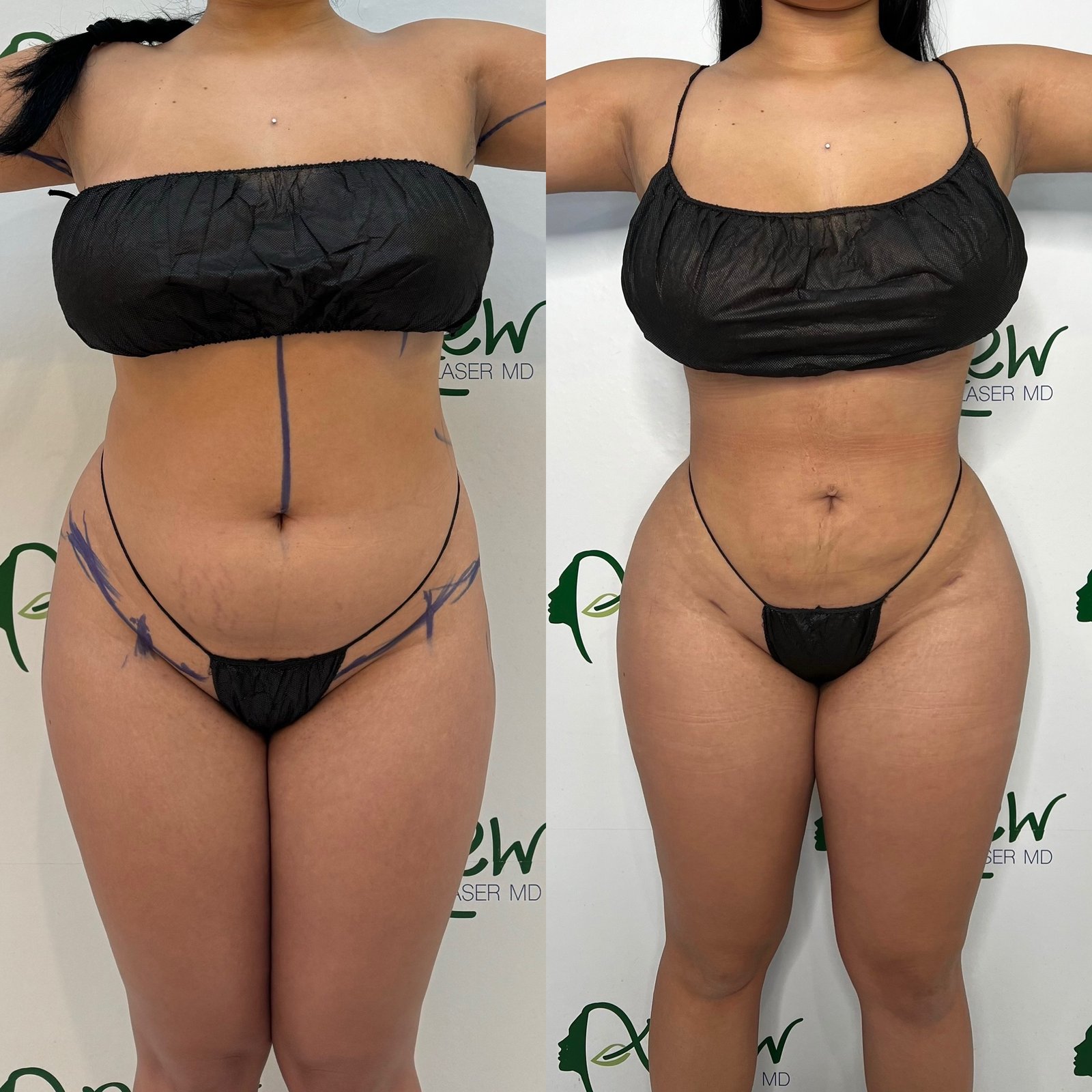 Lipo, BBl,, awake, sculptra results (2)