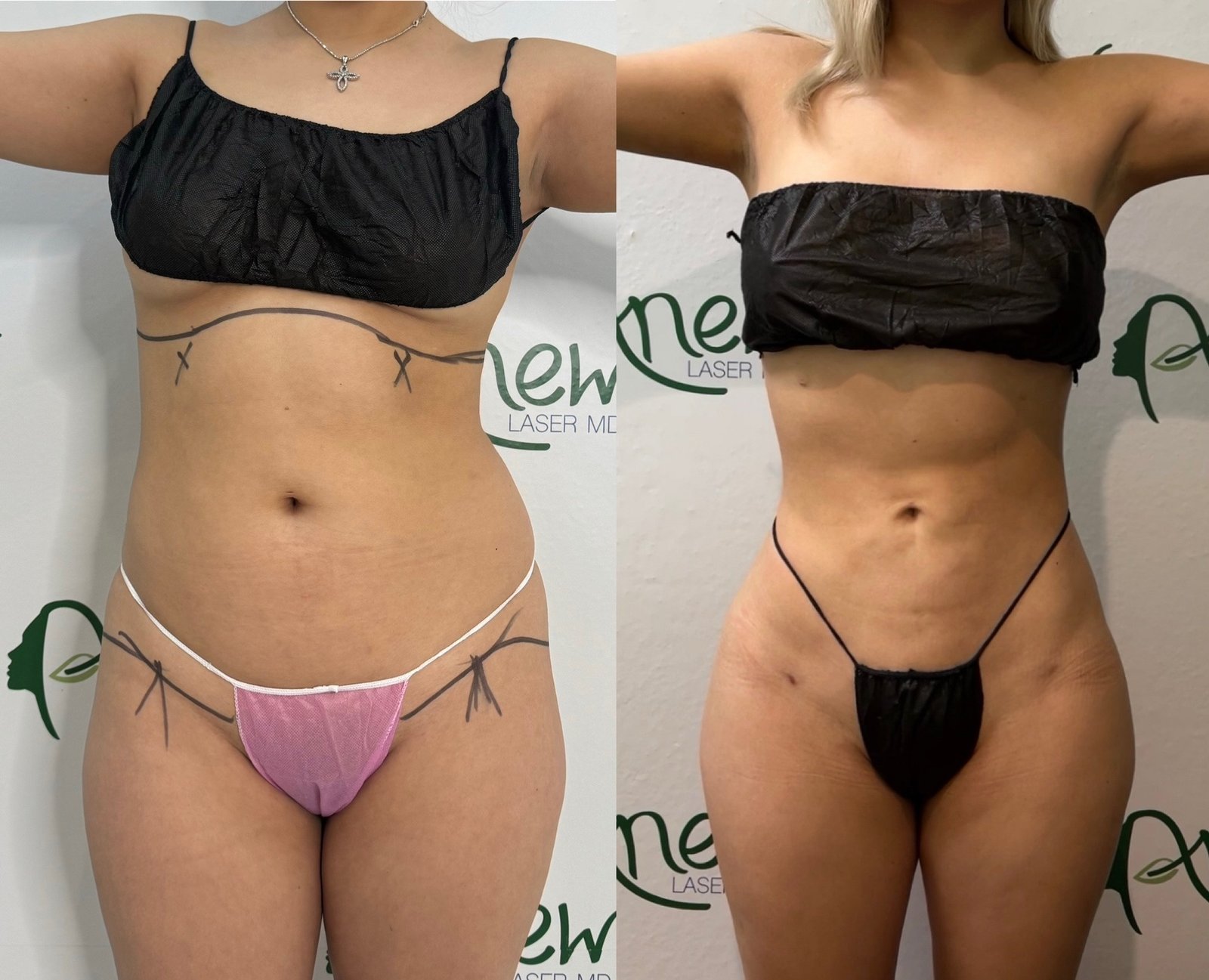 Lipo, BBl,, awake, sculptra results (3)