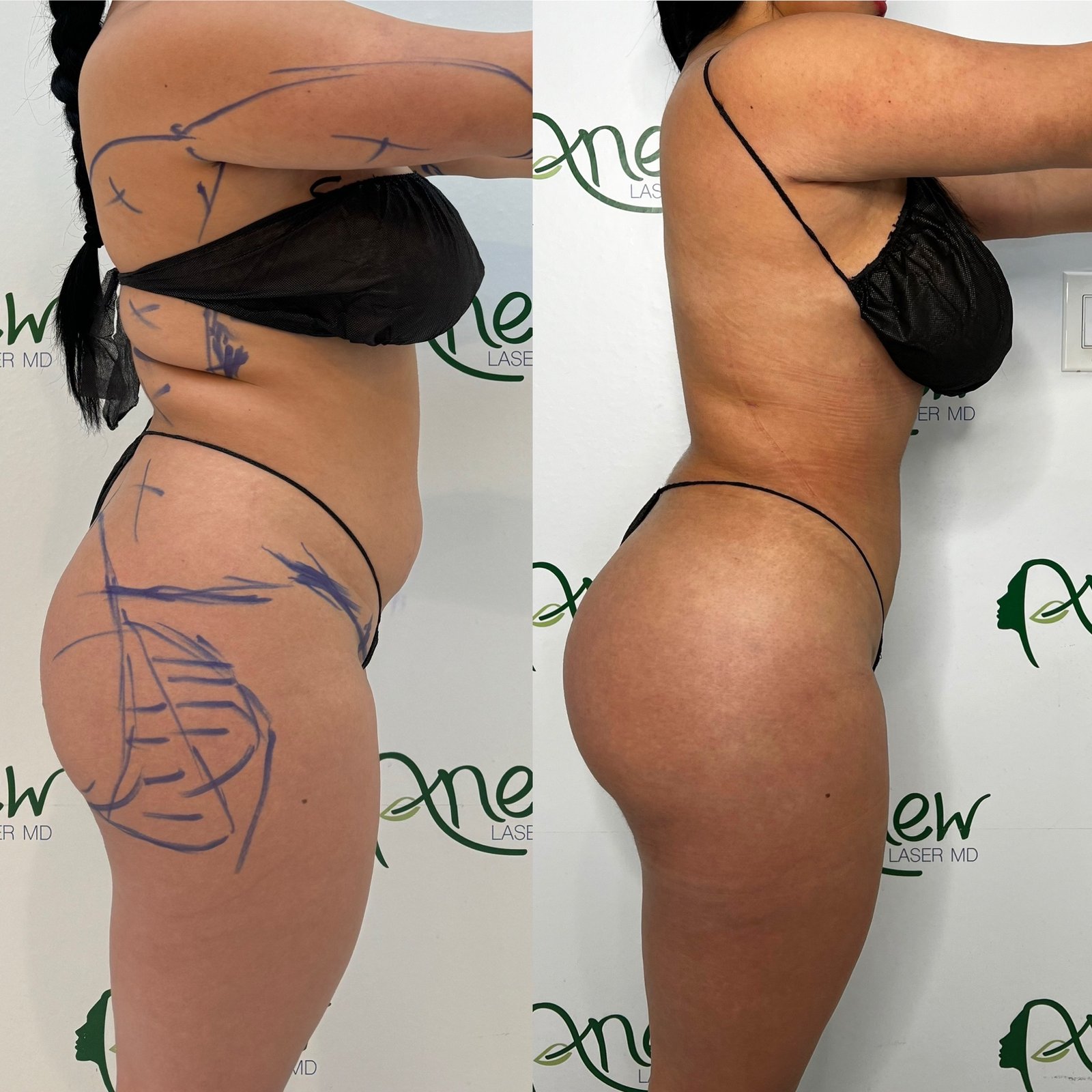 Lipo, BBl,, awake, sculptra results (4)