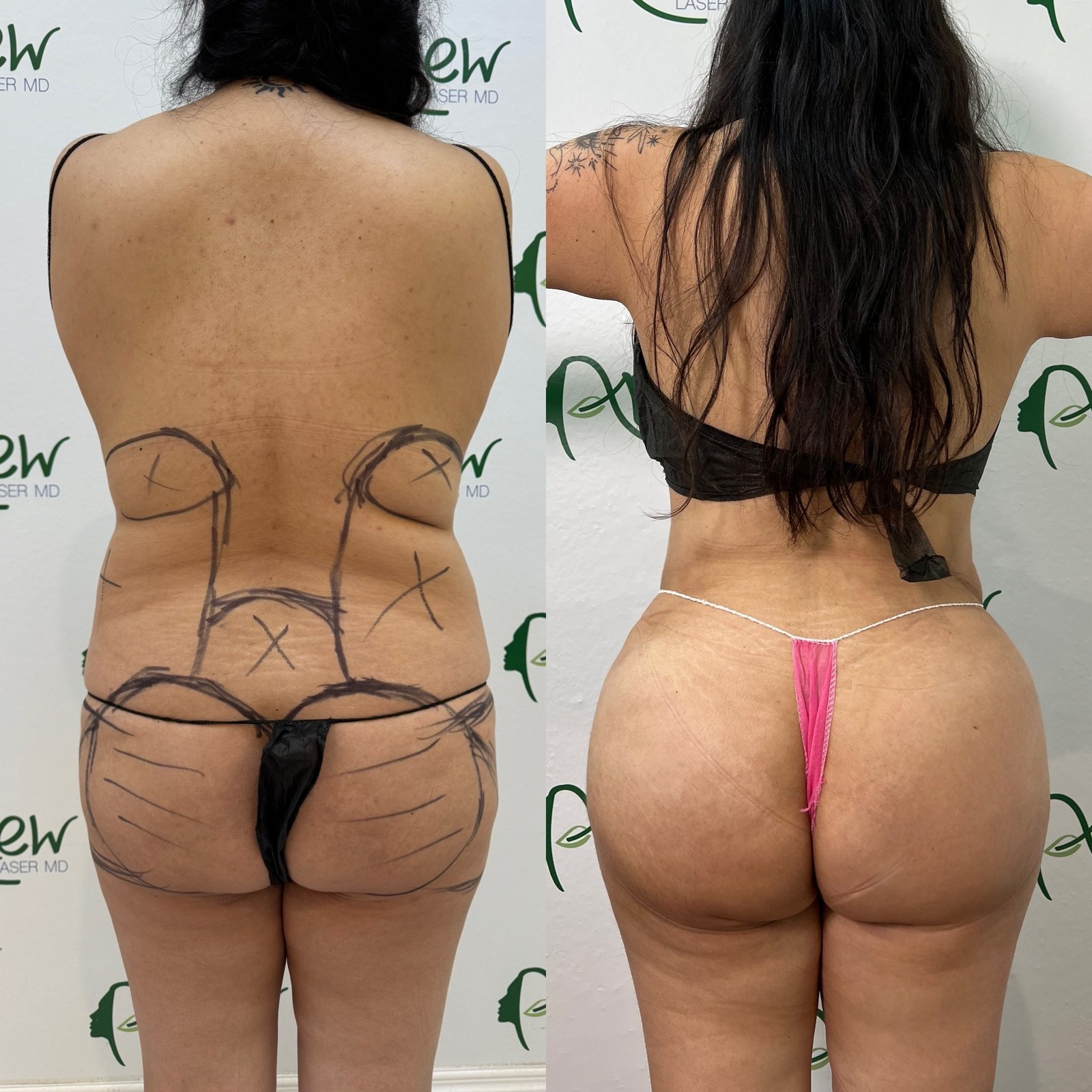 Lipo, BBl,, awake, sculptra results (5)