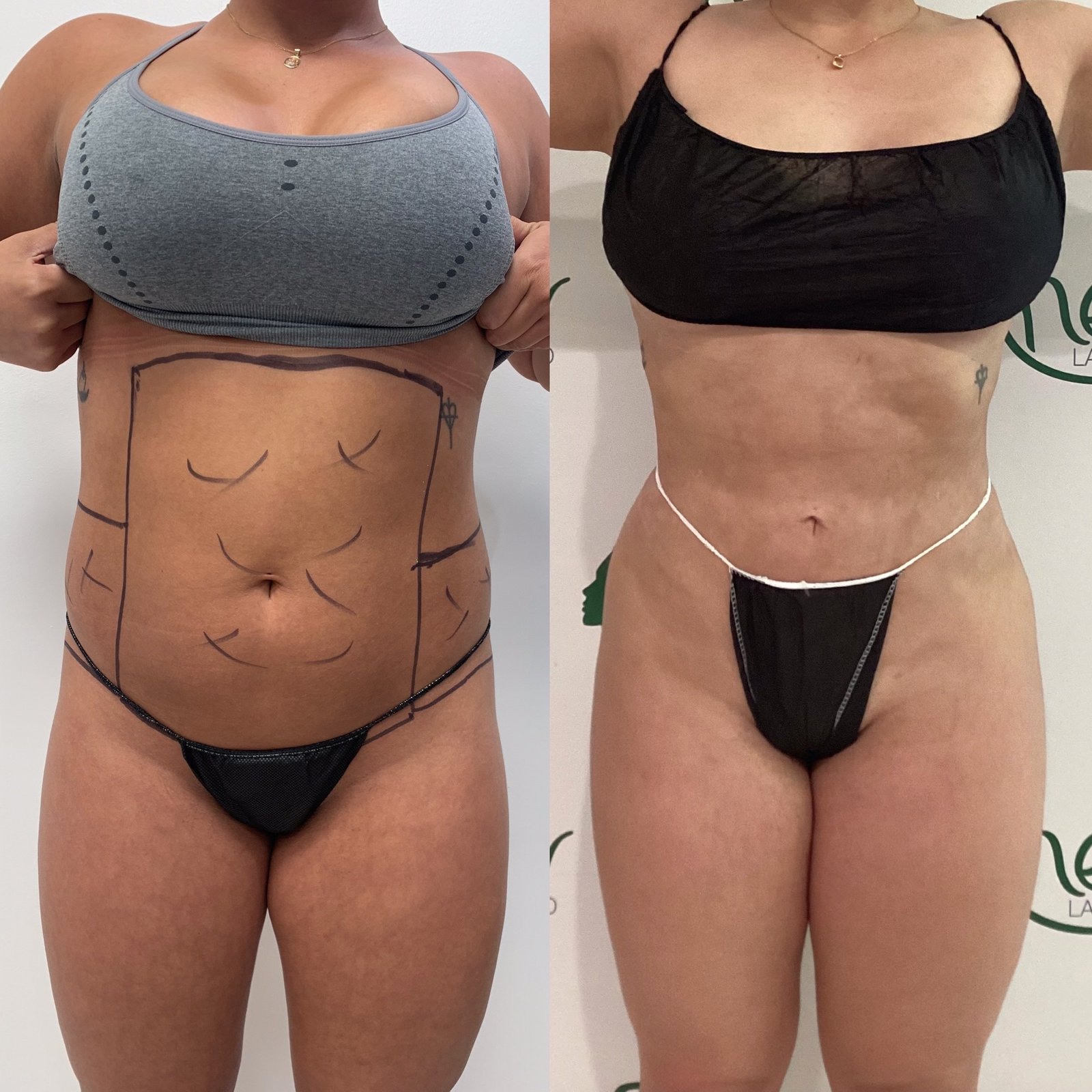 Lipo, BBl,, awake, sculptra results (6)